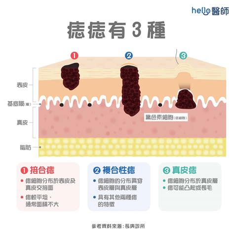 痣變大變凸|為什麼臉上的痣越來越多？皮膚科醫師解析長痣原因、。